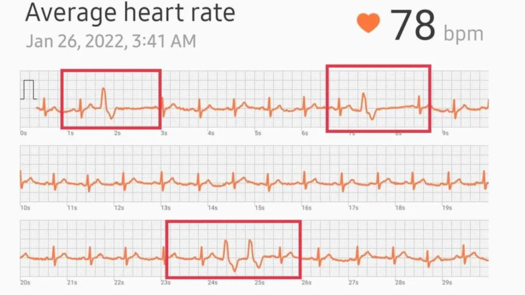 Galazy Watch ECG